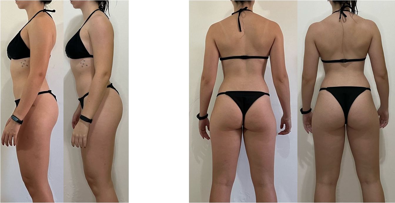 Antes e depois de aluna — vista lateral e posterior